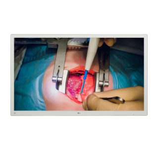 M&Agrave;N H&Igrave;NH PHẨU THUẬT NỘI SOI LG 4K IPS 55'' 55MH5K