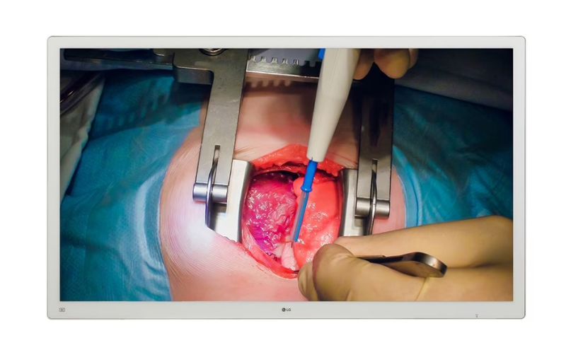 M&Agrave;N H&Igrave;NH PHẨU THUẬT NỘI SOI LG 4K IPS 55'' 55MH5K